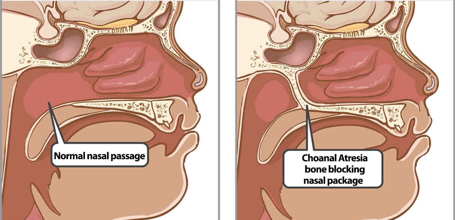 nasal choanae