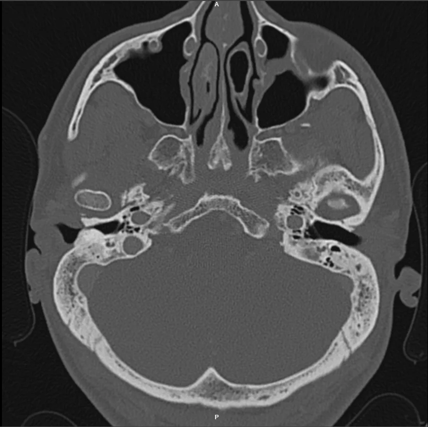 Exostosis Right External Auditory Canal