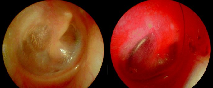 Acute Otitis Media