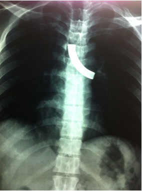 fractured tracheostomy tube in the airway