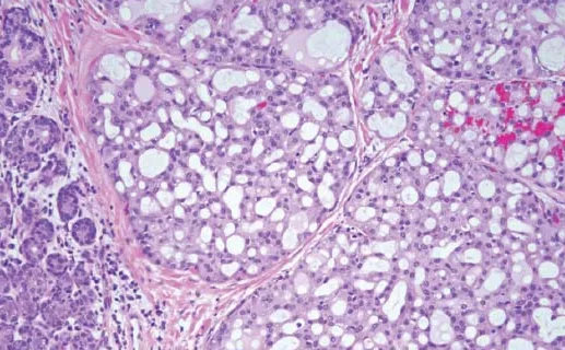 Mammary analogue secretory carcinoma (MASC) is composed of uniform cells with vesicular nuclei, centrally located nucleoli and well-developed eosinophilic cytoplasm. Cells are arranged in a cribriform manner or surround wider spaces that contain secretory material (Hematoxylin and eosin, x220) - Image Courtesy - BJBMS