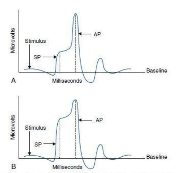 Electro Cochleography in Meniere's. A) Normal ear, B) Normally ratio of summating potential (SP) to action potential (AP) is 30%; this ratio is higher in Meniere's.