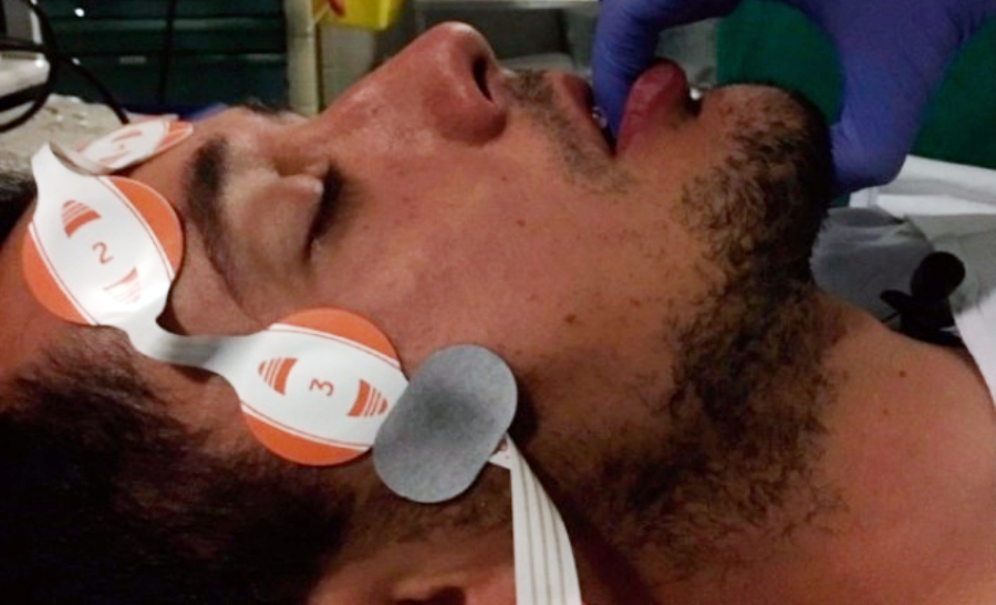 Patient with BIS electrodes connected for DISE
