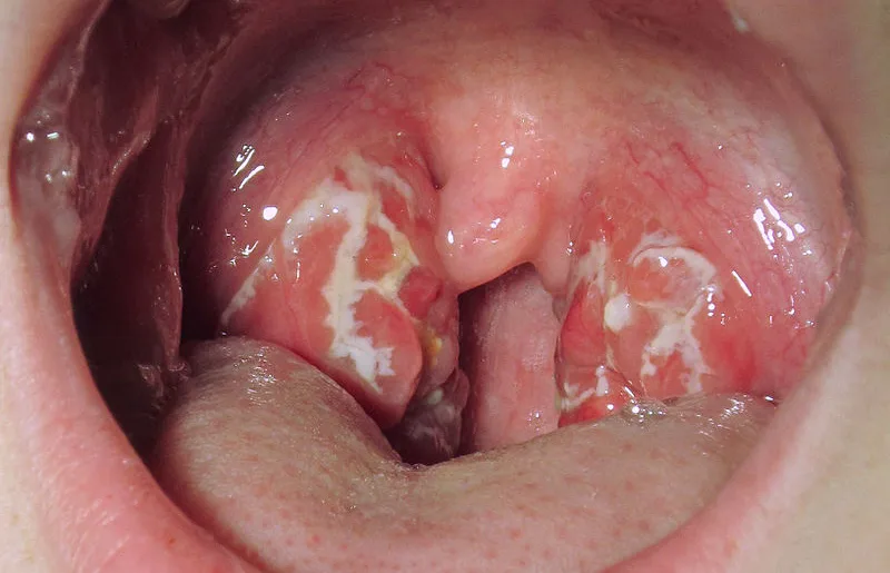 Acute tonsillitis