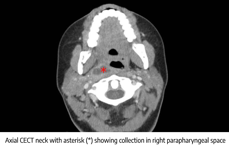 Axial CECT Showing Parapharyngeal abscess