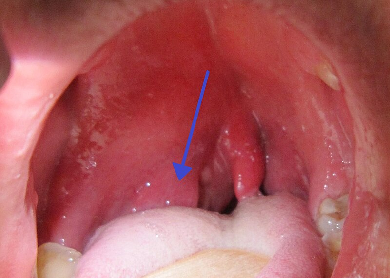 A right sided peritonsilar abscess