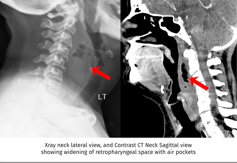 Retropharyngeal abscess radiology