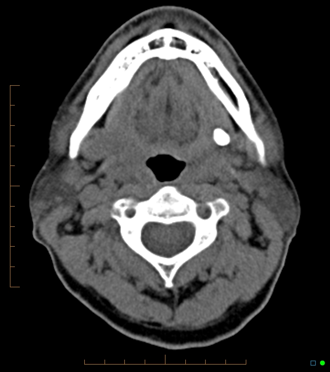 Chronic Submandibular Sialolithiasis