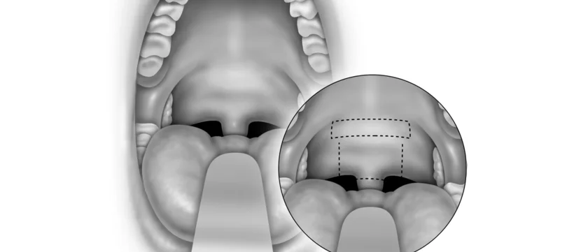 Anterior Palatoplasty / Cautery-Assisted Palatal Stiffening Operation