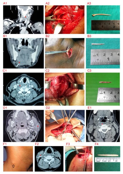 Lost and Found: Surgical Adventures in Migratory Foreign Body Cases