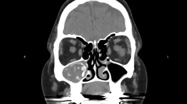 Fungal rhinosinusitis – Clinical features, Types and Management