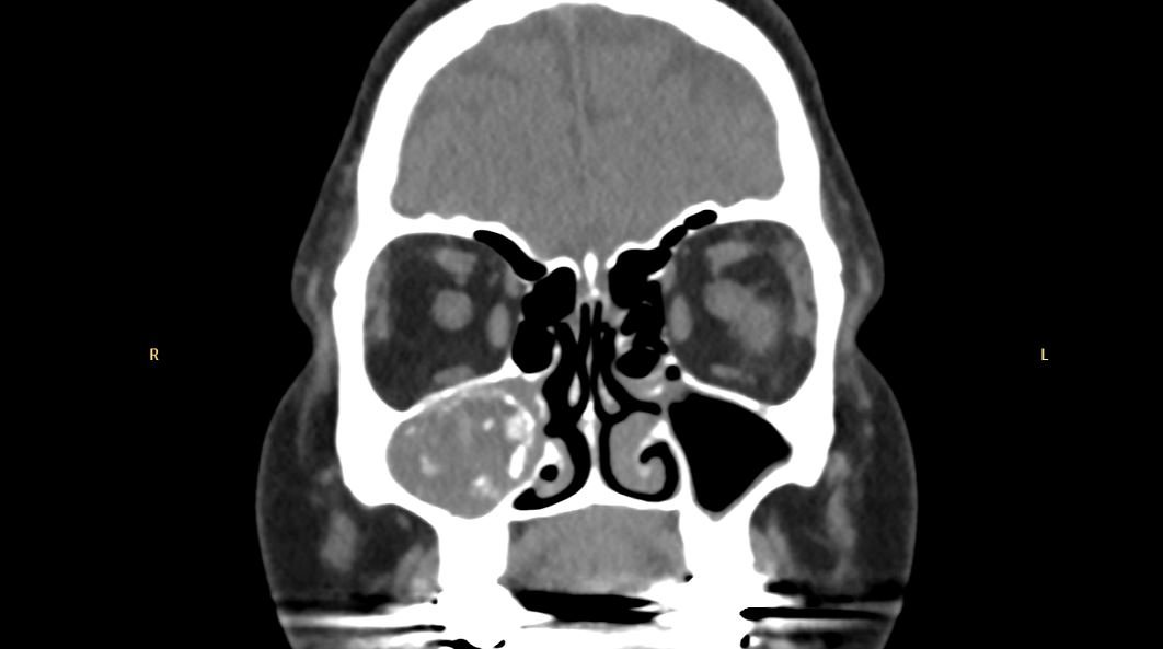 Fungal rhinosinusitis – Clinical features, Types and Management