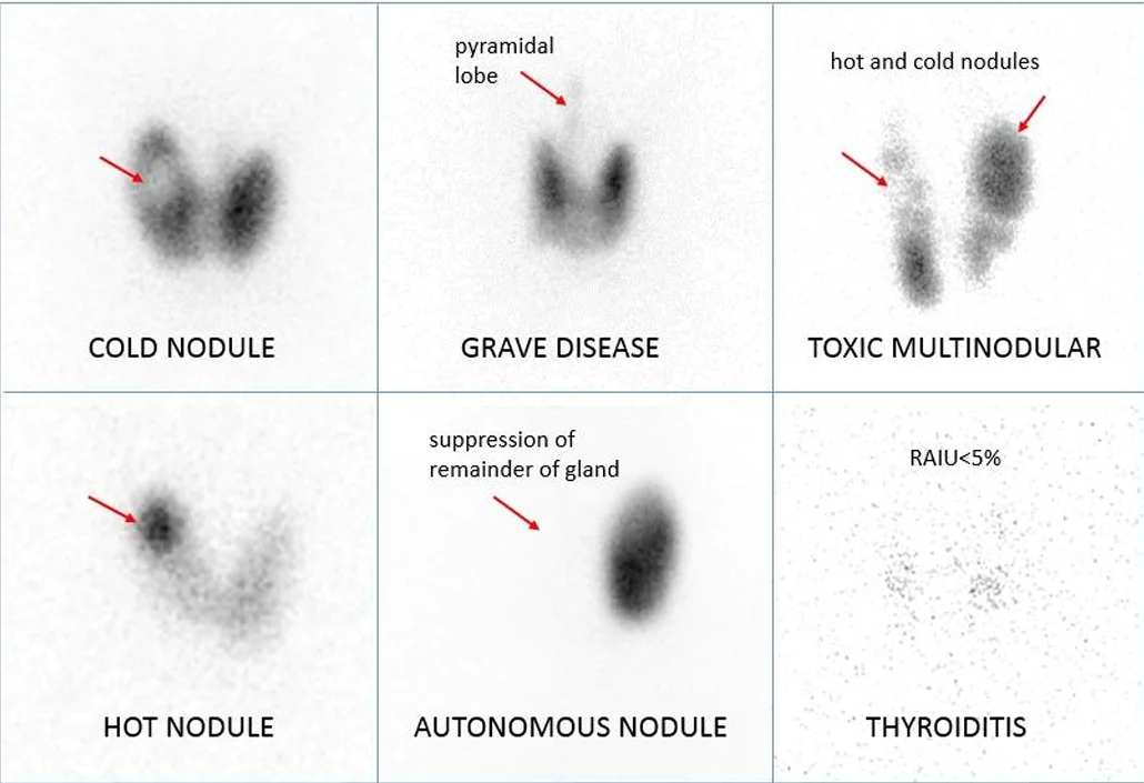 hot and cold nodules thyroid