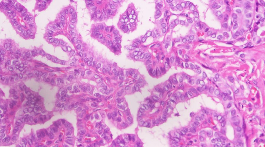 Histopathology of papillary carcinoma thyroid - complex, branching, randomly oriented papillae with fibrovascular cores.. Change of nuclear size and shape: nuclear enlargement, elongation and overlapping Chromatin characteristics: chromatin clearing / optically clear chromatin, chromatin margination, glassy / ground glass nuclei, Orphan Annie nuclei Nuclear membrane irregularity: irregular nuclear contour, nuclear grooves and nuclear pseudoinclusions