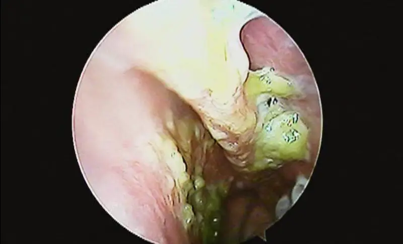 Atrophic Rhinitis