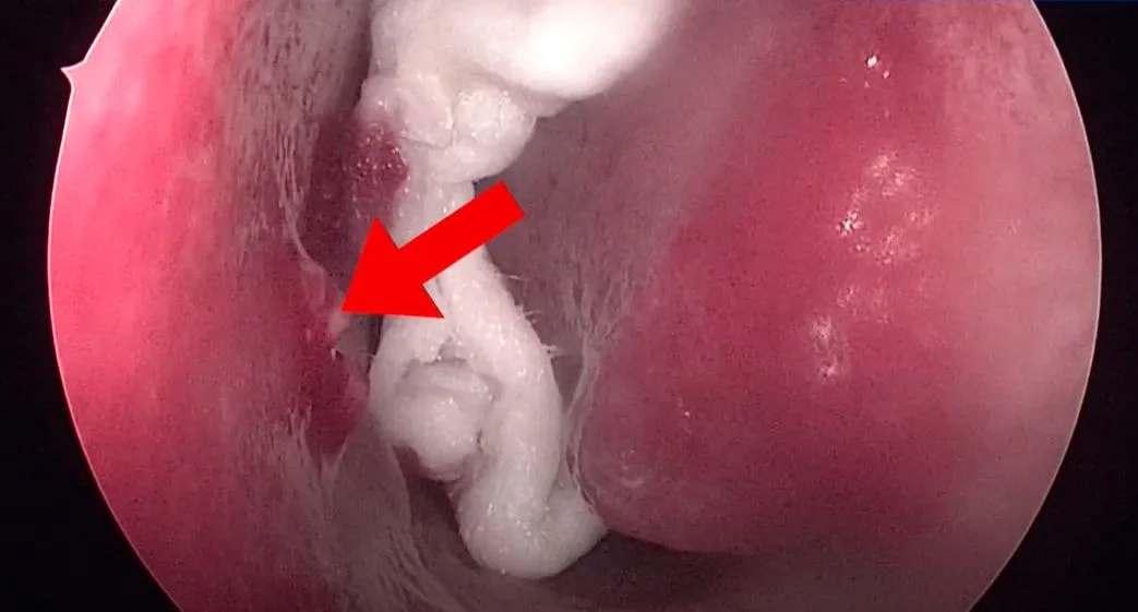 Pyogenic Granuloma of the Nasal Septum
