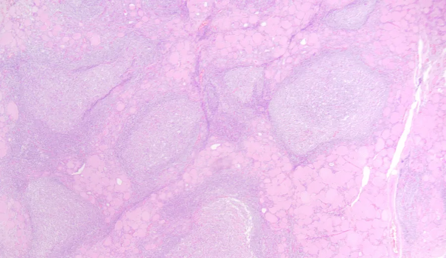 Lymphocytic thyroiditis - Histopathologic appearance of Hashimoto's thyroiditis - diffuse infiltration of thyroid parenchyma with lymphocytes and plasma cells; lymphoid follicle formation with germinal centers.
