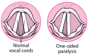 ENT_vocal_cord_paralysis