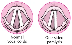 ENT_vocal_cord_paralysis